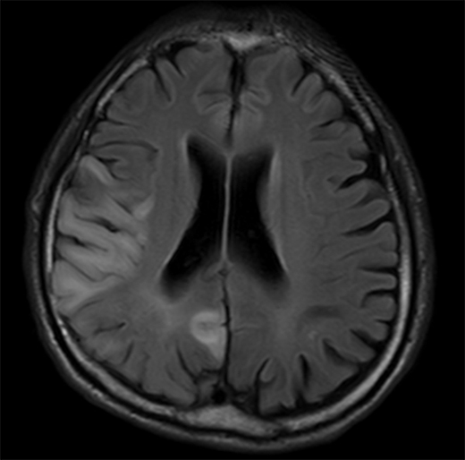 図３. 脳卒中様発作のMRI画像